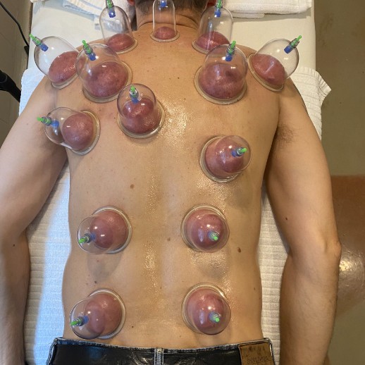 Cupping