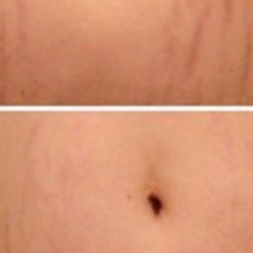 Microneedling af strækmærker