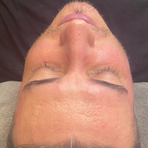 Microneedling af øjenområde + omkring munden eller små områder