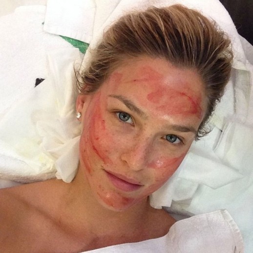 Vampyr ansigtsbehandling uden PRP